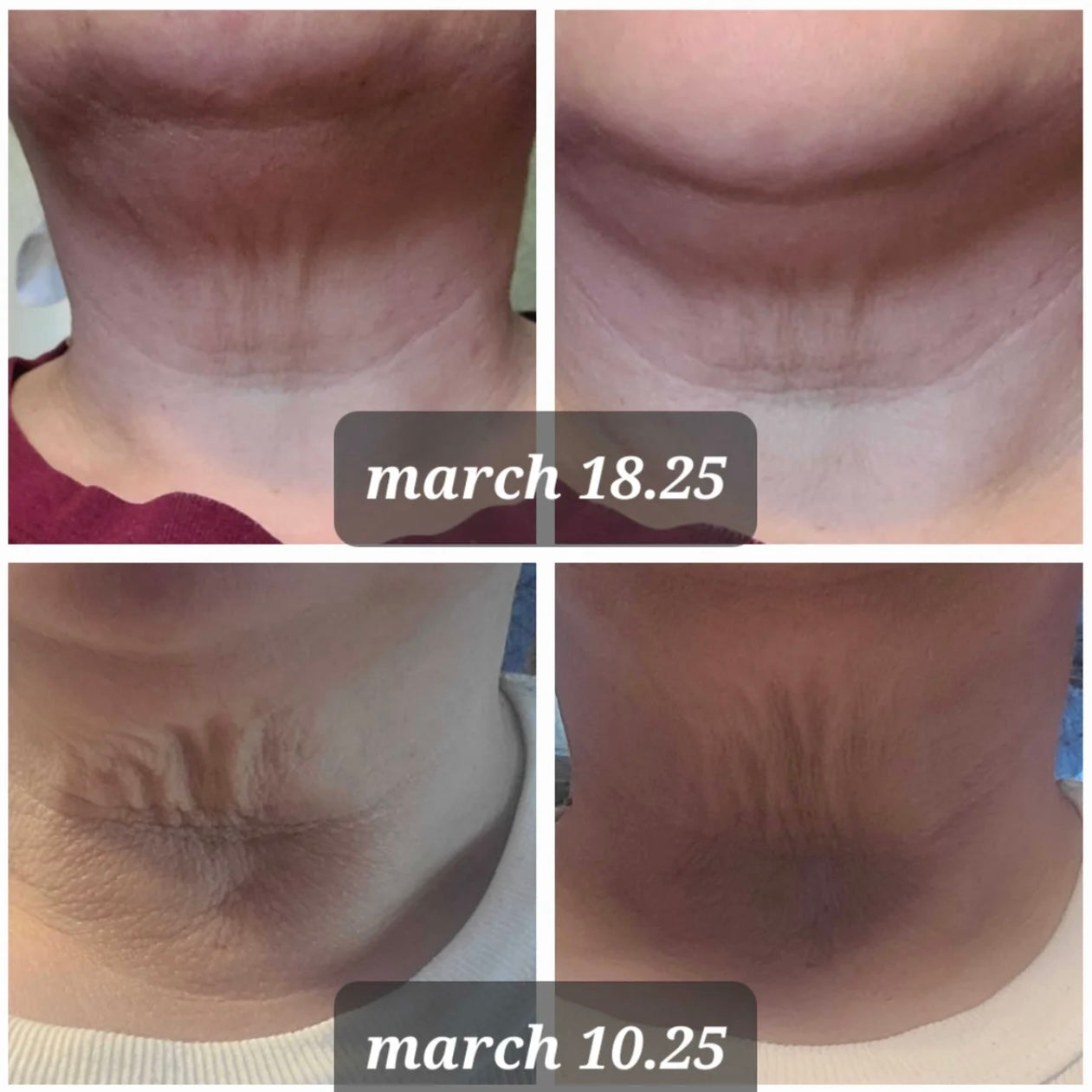 NeckLift™ – Transform Your Neck Today